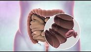 What is bowel cancer? | Cancer Research UK