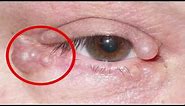 Eyelid Cysts : eyelid cysts treatment || how to get rid of a stye