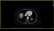 Pancreas Imaging - Obstructive Chronic Pancreatitis
