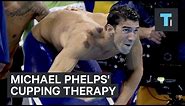 Michael Phelps' cupping therapy