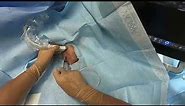 ICU Point of View: Placing a midline catheter (modified Seldinger)