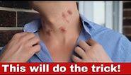 How to Get Rid of Hickeys: 11 Proven Methods to Clear Your Skin Quickly!
