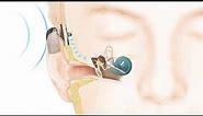 How the Cochlear™ Baha® Attract System works