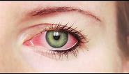 Eye Insight: What is Myopia?