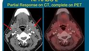 Surveillance Imaging for Head and Neck Cancer: The Rise of NIRADS