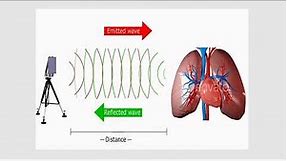 Robust mm-Wave Radar Based Heart and Breathing Rate Monitoring