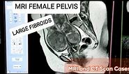 MRI Female Pelvis with Contrast - Diagnosing Large Fibroids.