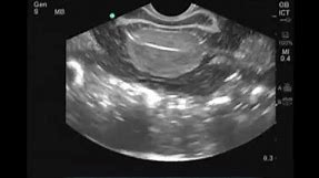 How to: Female Transvaginal Ultrasound Exam