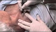 Removal of old age warts (seborrheic keratoses) from neck