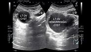 Ultrasound Video showing difference between functional ovarian cyst and Hemorrhagic Ovarian Cyst.