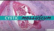 Molluscum Contagiosum (cystic!): 5-Minute Pathology Pearls