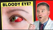 Broken Blood Vessel And Bloodshot Eye?! - Subconjunctival Hemorrhage (Causes, Treatment)