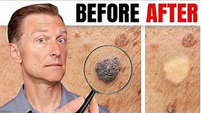 How to Remove Skin Tags and Warts Overnight - Dr. Berg Explains
