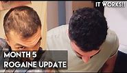 5 Month Rogaine Update (Minoxidil) - IT WORKS!!