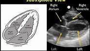 How to: Echocardiography - Subxiphoid View