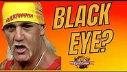 Why did Hulk Hogan have a BLACK EYE at WrestleMania 9?