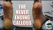 EXTREME UNBELIEVABLE NEVER ENDING THICKEST FOOT CALLUS/CALLOUS REMOVAL