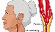 Carotid Artery Stenosis: Causes, Symptoms and Treatment