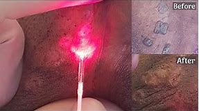 Warts Removal With Advanced Laser Treatment - Laven Clinic Group