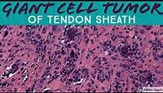 Giant Cell Tumor of Tendon Sheath: 5-Minute Pathology Pearls