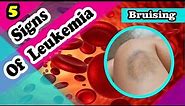 5 Leukemia Signs and Symptoms You Should Know