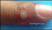 Wart Removal - Cryotherapy