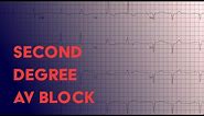 Second Degree Heart Block - Electrocardiogram (ECG/EKG) Interpretation