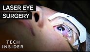 What It's Like To Get Laser Eye Surgery