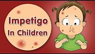 Impetigo in Children - Signs, Causes & Treatment