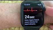 Apple Watch EKG/ECG - PVCs with Interpolated PVCs