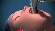 Endotracheal Intubation Animated