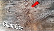 Piking out million giant lice from girl's head - Lice combing