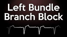 Left Bundle Branch Block ECG Explained