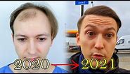 FUE Hair Transplant Growth Timeline | Before & After