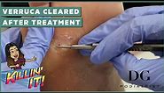 Verruca removal treatment with clearal results | The Foot Scraper: DG Podiatrist