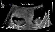 Scan of the Week: Twins at 9 weeks gestation!
