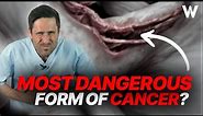 Pancreatic cancer: Important signs! Early detection & therapy for pancreatic cancer diagnosis