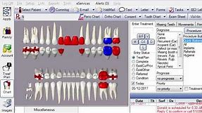 Charting Progress Notes in Open Dental