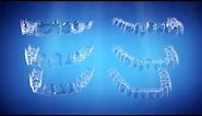 Straight Talk About Crooked Teeth | Invisalign