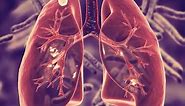 Everything you need to know about a LUNG NODULE, in 6 minutes