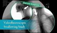 Barium Swallow (Barium Esophagram: Anterior-Posterior View)