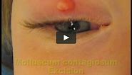 Molluscum contagiosum Removal from around the eye