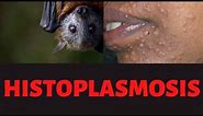 HISTOPLASMOSIS SYMPTOMS CAUSES TREATMENT: Histoplasma Capsulatum: What is Histoplasmosis?