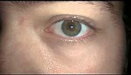 Central Heterochromia