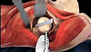 Femoral Head Osteotomy Animation - Direct Anterior Total Hip Replacement