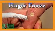 Finger Wart Cryotherapy Probe | Auburn Medical Group
