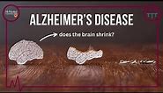 Forget Me Not: Alzheimer's research