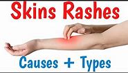 Skin Rash | Causes, Symptoms, Types & Diagnosis |