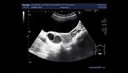 Ultrasound Video showing difference between the simple and hemorrhagic ovarian cysts.