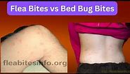 Flea Bites vs Bed Bug Bites | How to Tell Which One You Have